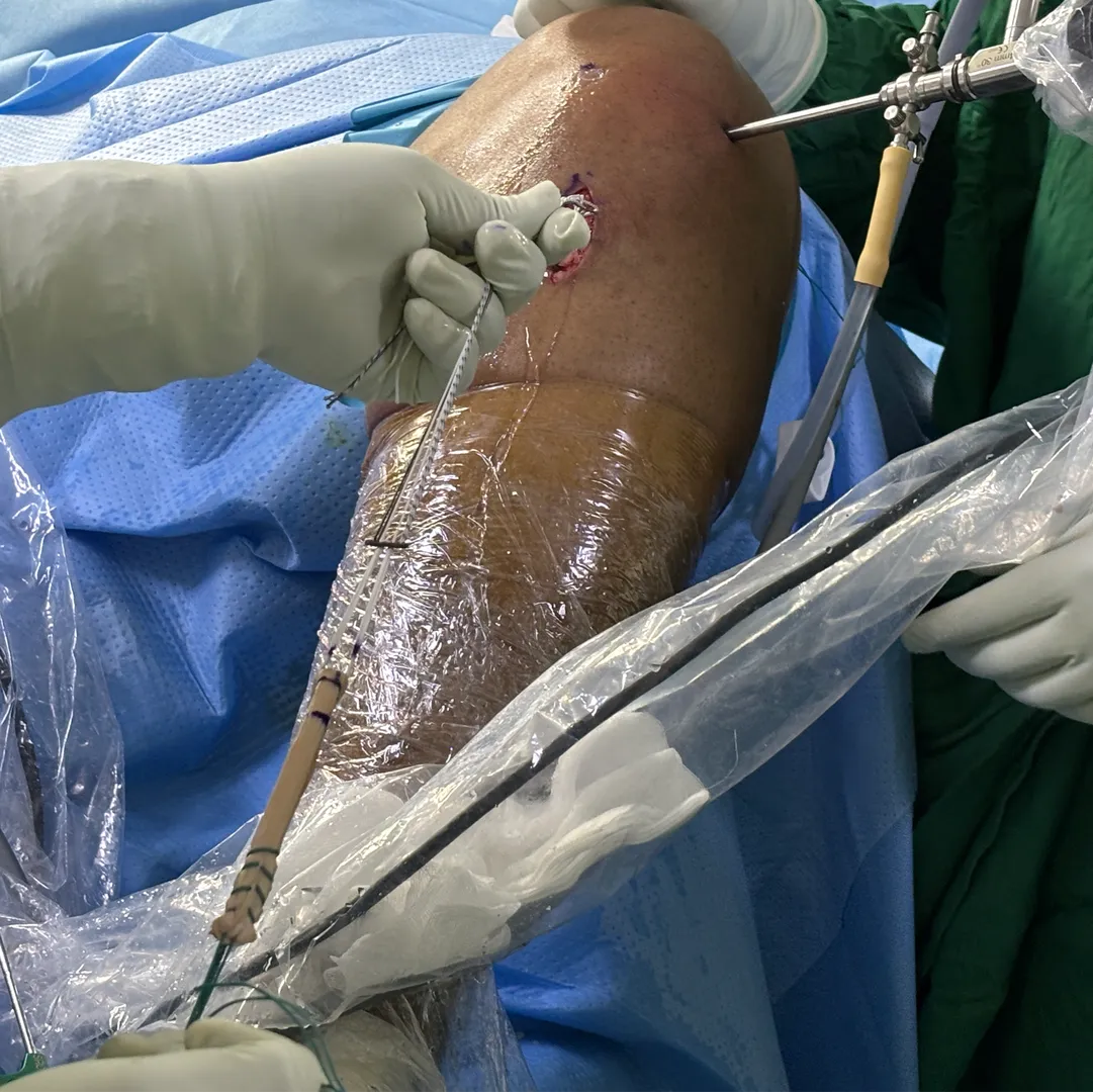 Arthroscopic ACL reconstruction surgery with meniscus repair done successfully