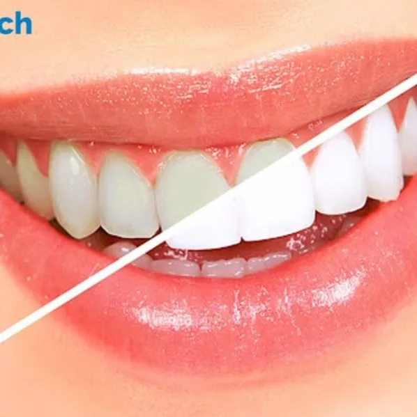 Best Tooth Cleaning Treatments In vashi navi mumbai