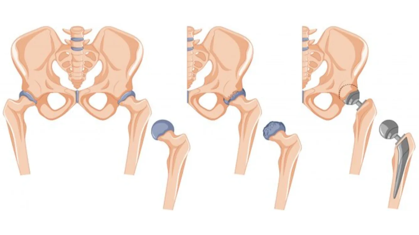 Total Hip Replacement in Nagarbhavi, Bangalore