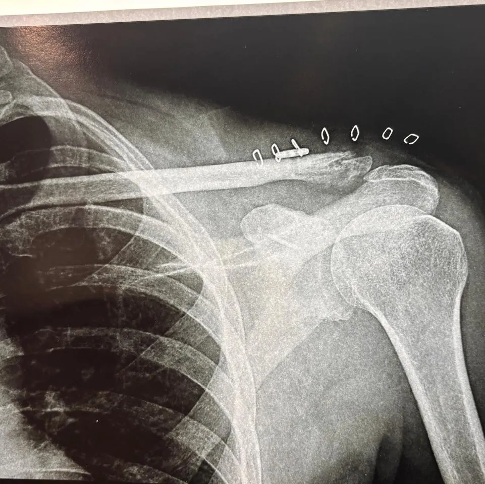 Fracture Clavicle operated successfully by fibre tape and Endobutton
