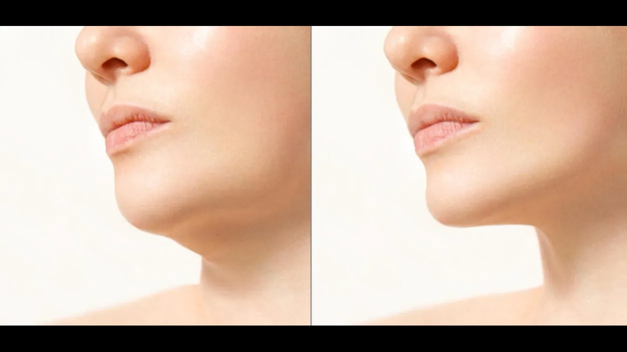 Chin Implant Surgery in Bengaluru – Precision Facial Enhancement