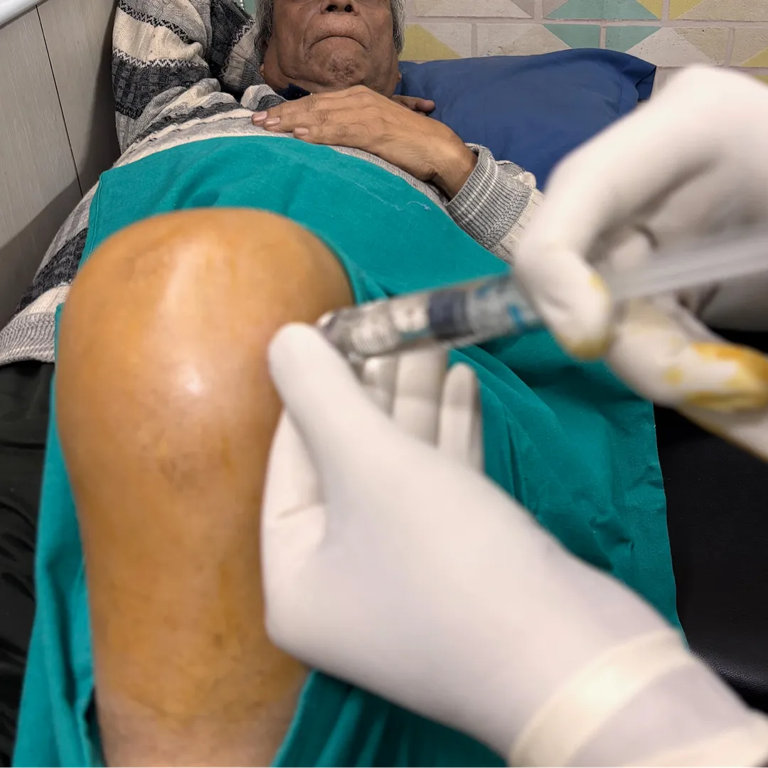 Viscosupplementation (sodium Hyaluronate) injection for Osteoarthritis knee.