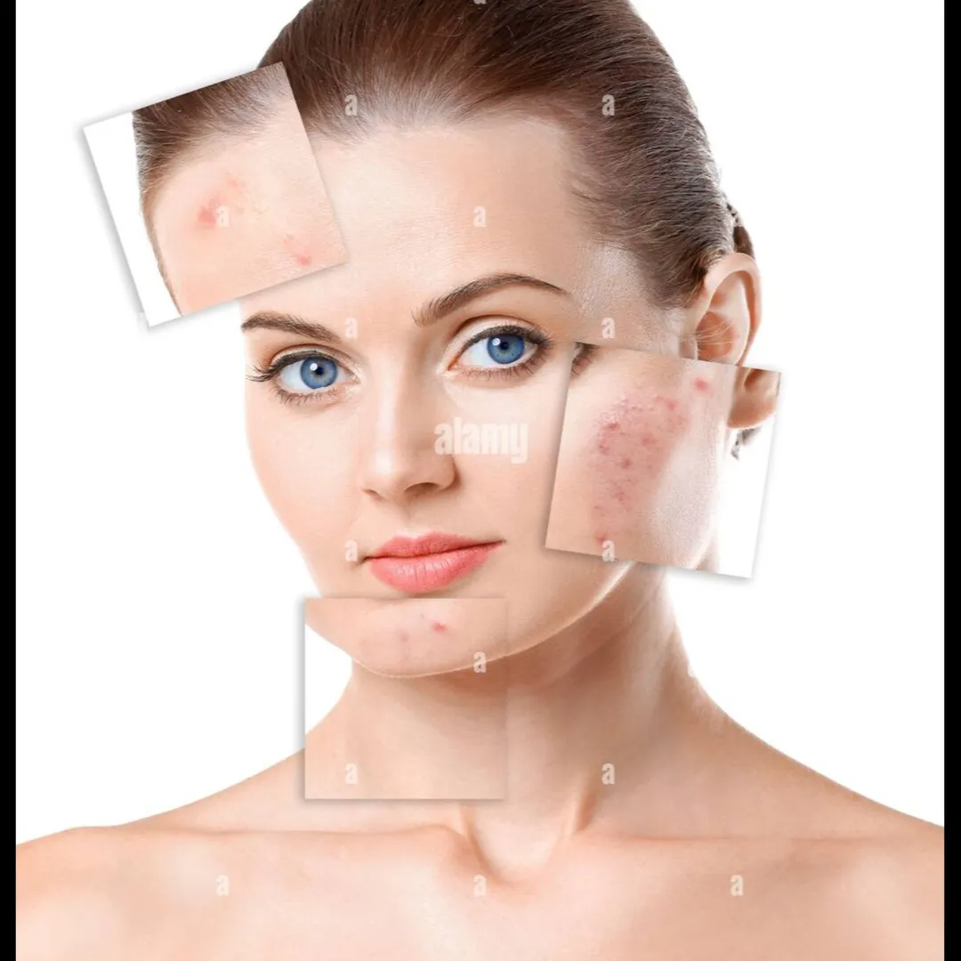 Acne Treatment in Vashi