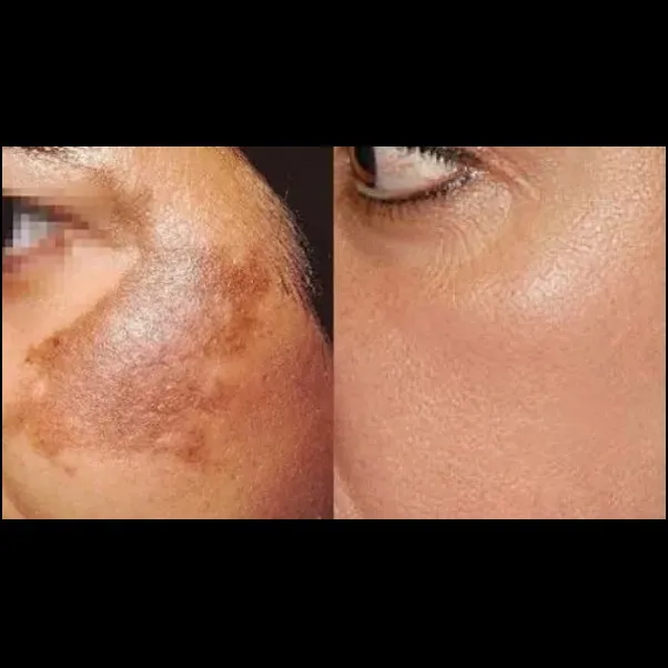 Pigmentation Treatment in Vashi