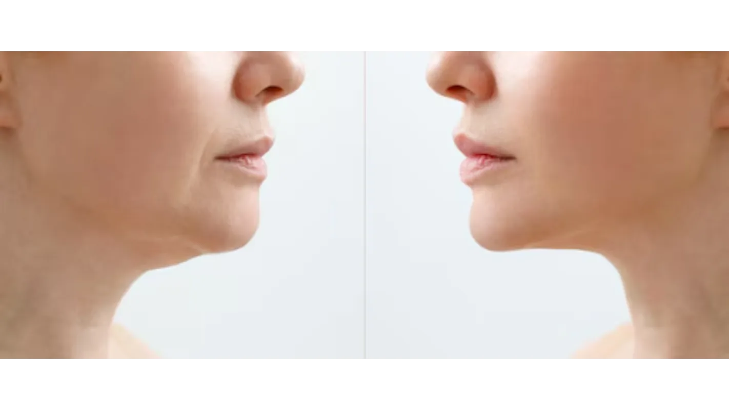 Buccal Fat Removal in Bengaluru – Defining Facial Contours Naturally