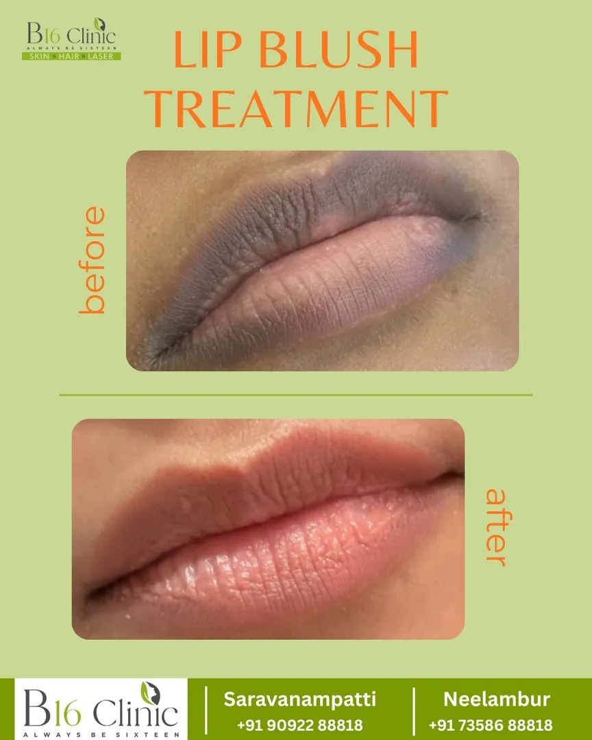 πΈ Lip Blush Treatment at B16 Clinic β Neelambur & Saravanampatti
At B16 Clinic (Skin | Hair | Lase...
