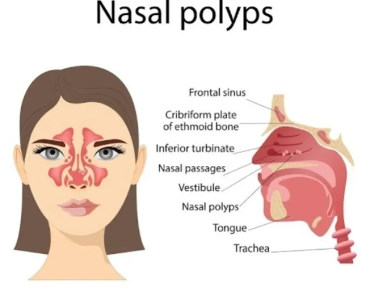Nasal Polyposis Surgery in Nashik for Chronic Nasal Blockage