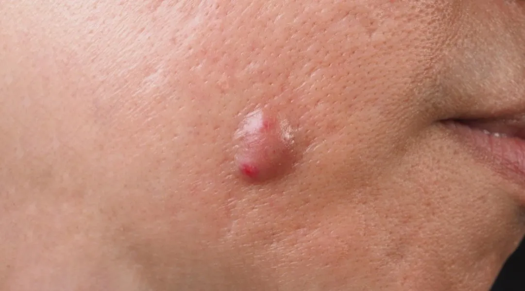 Sebaceous Cyst Surgery in Sion for Safe Removal and Aesthetic Results