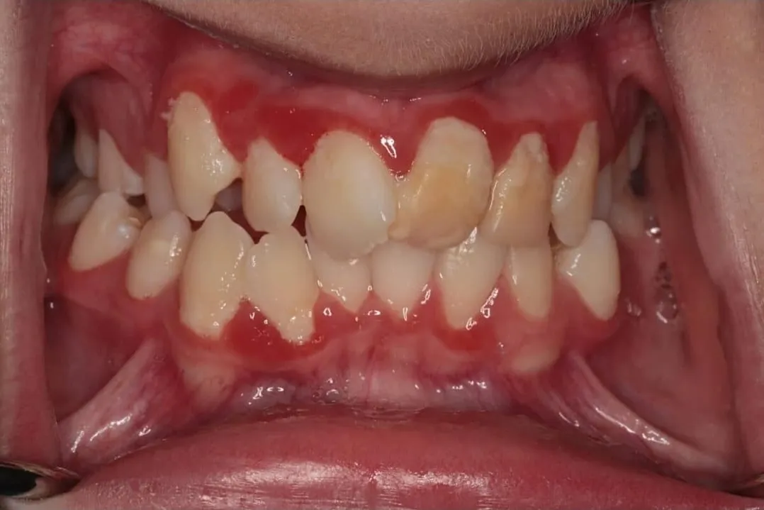 Gum Bleeding While Brushing – Do You Need Teeth Cleaning?