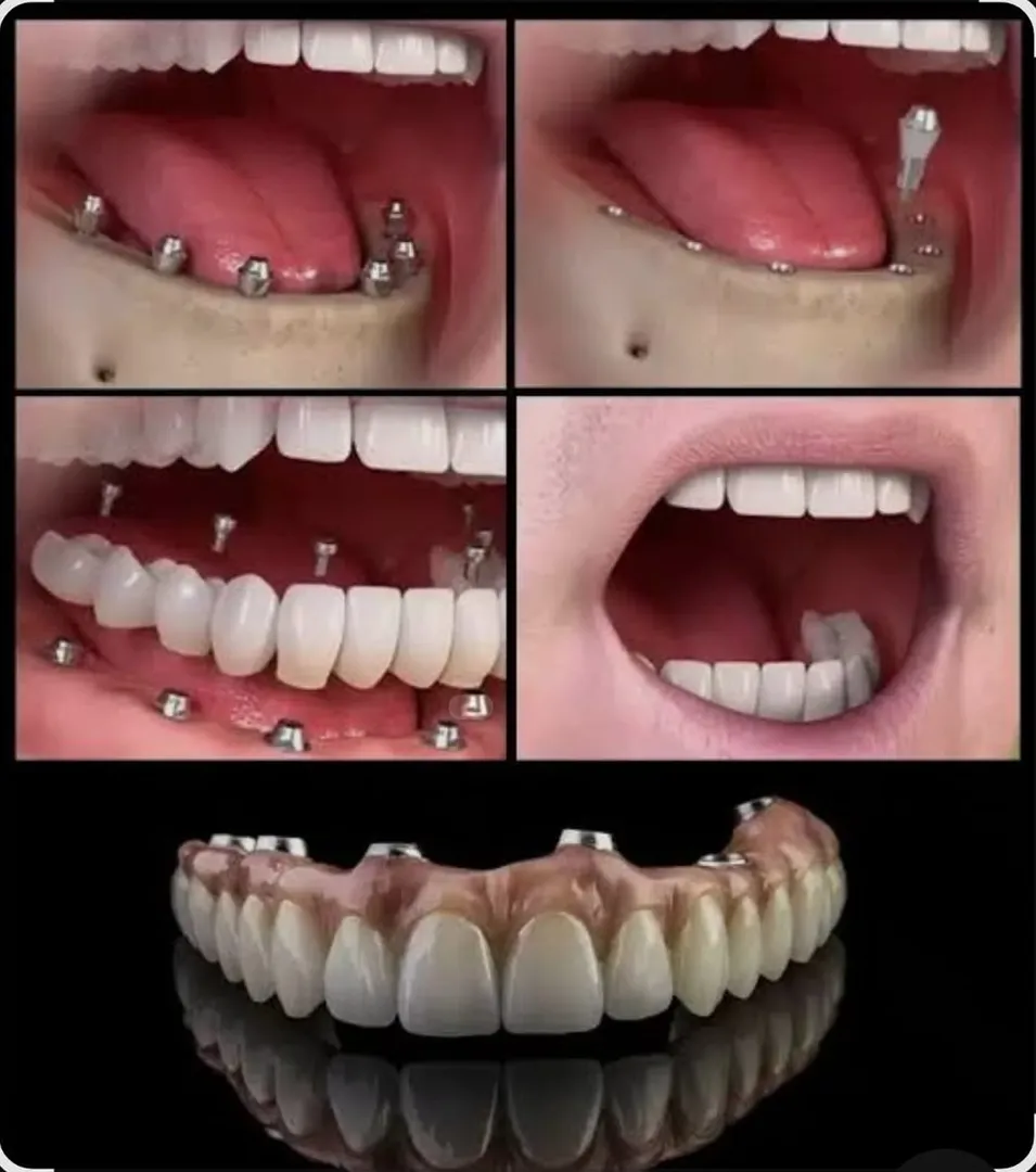 Dental Implants for Seniors – Is Age Just a Number?