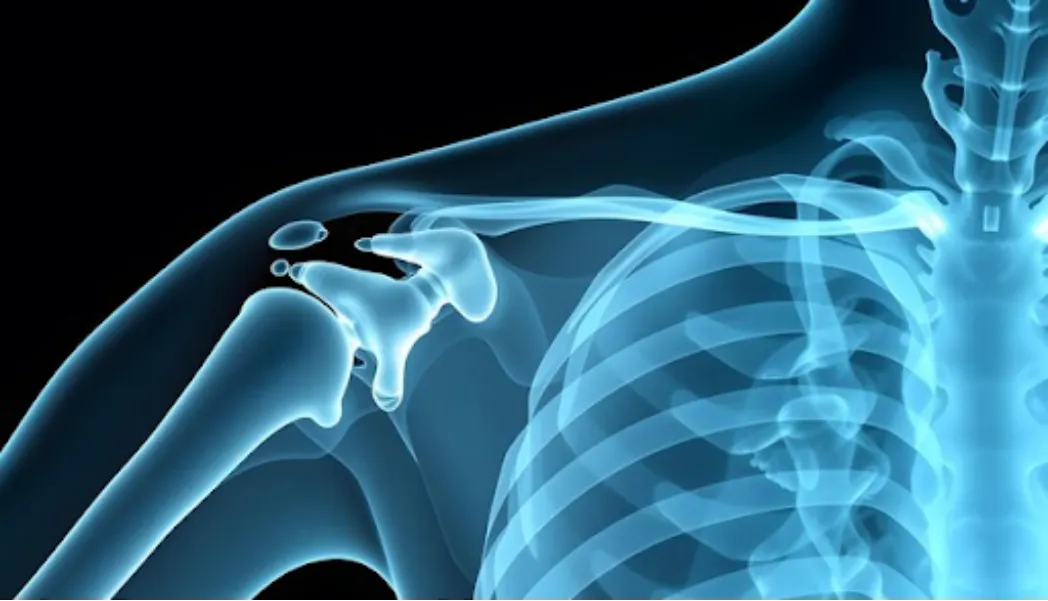 Shoulder Replacement Surgery in Bangalore – A Step Towards Pain-Free Daily Living