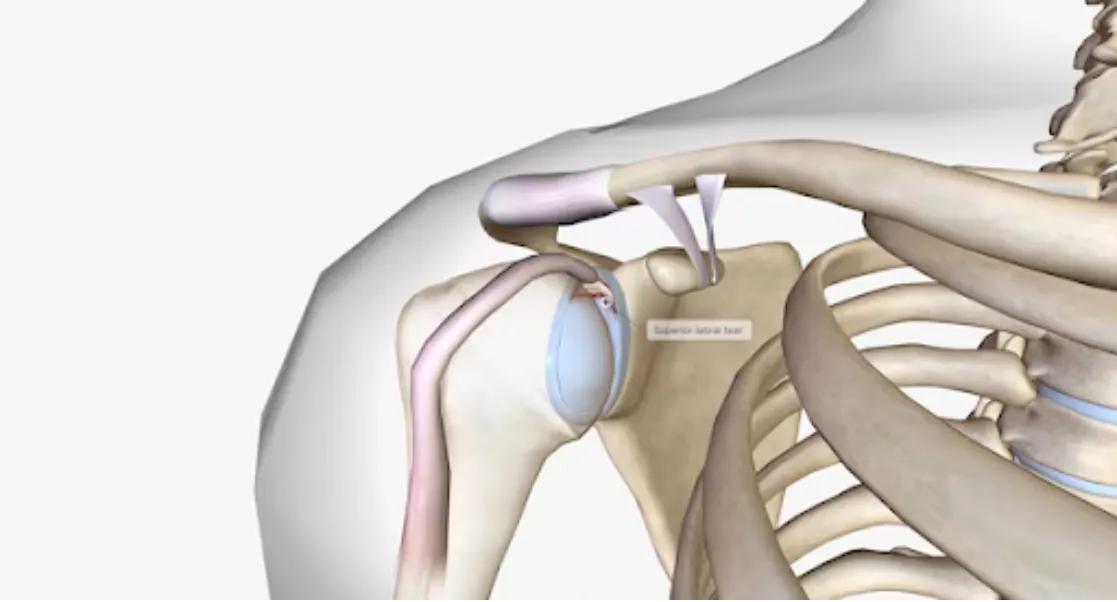Reverse Shoulder Replacement Surgery in Bangalore – Advanced Care for Complex Shoulder Conditions