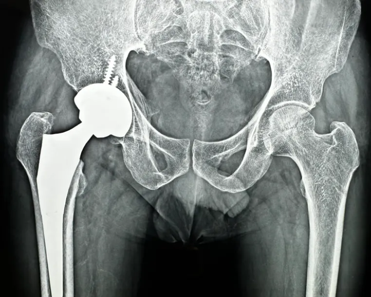 Hip Replacement Surgery in Nagpur – When Walking Should Not Hurt