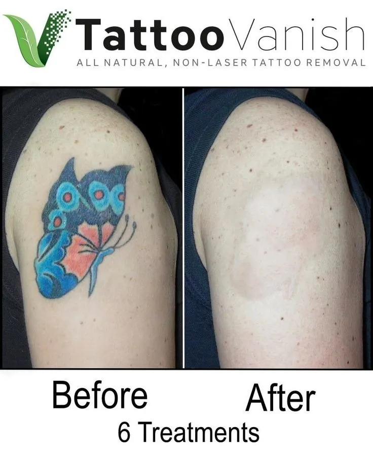 Tattoo removal treatment In vashi