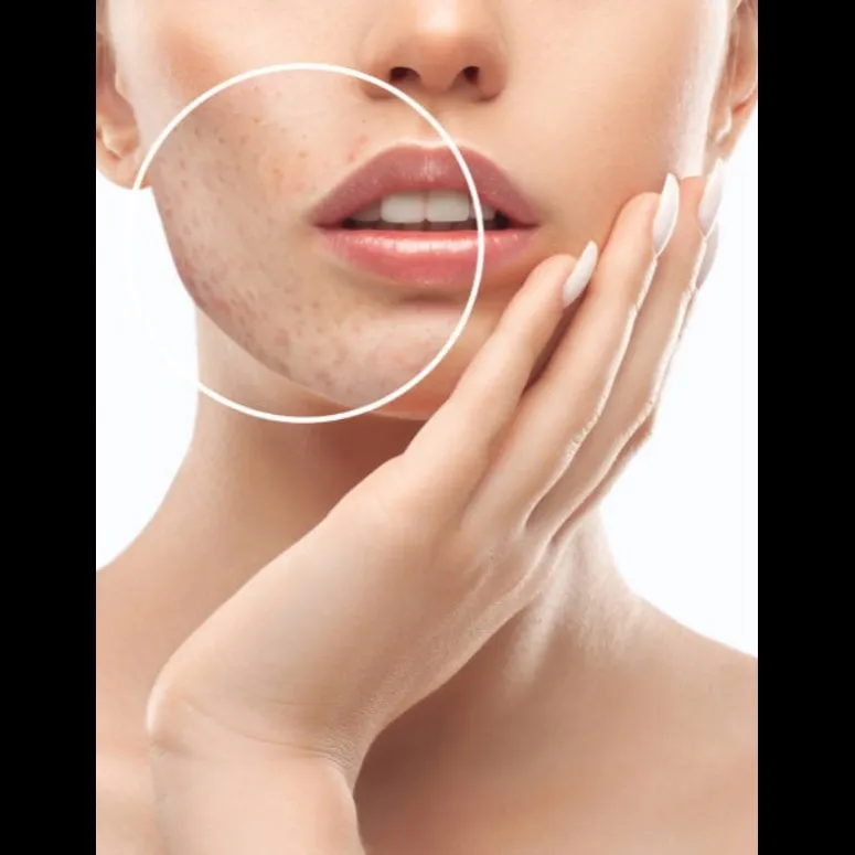Scar removal treatment In vashi