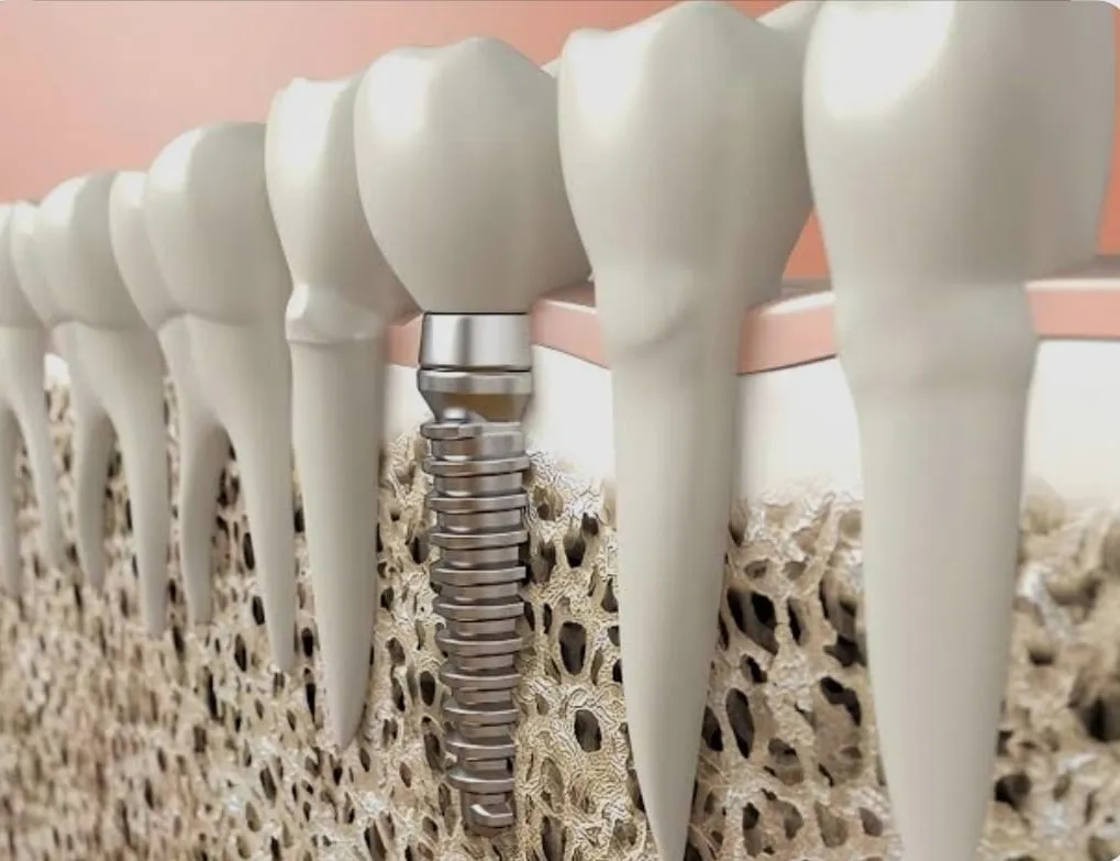 Can I Get an Implant If I Have Weak Bone?