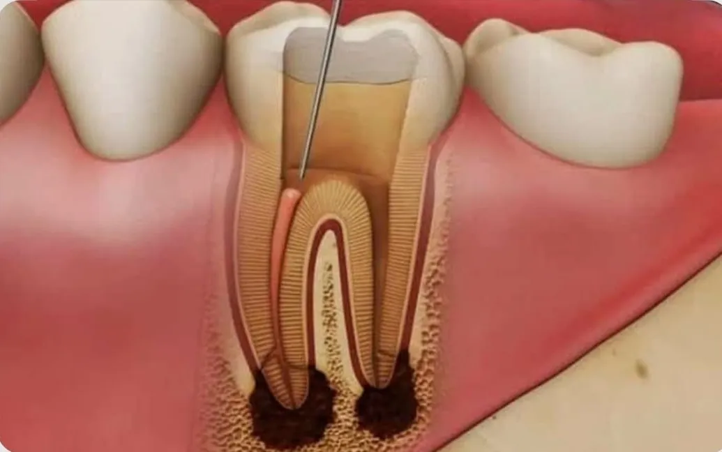 Why Do Some Root Canals Fail?