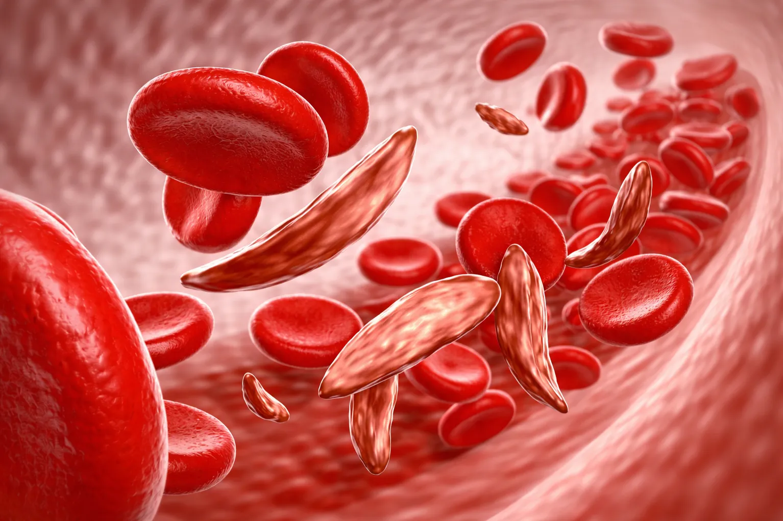Sickle Cell Disease Treatment for Children in Nagpur with Long Term Care Planning