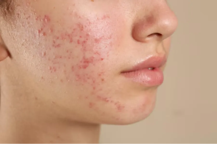 Acne Treatment in Kohat Enclave - Clear Skin, Confident You