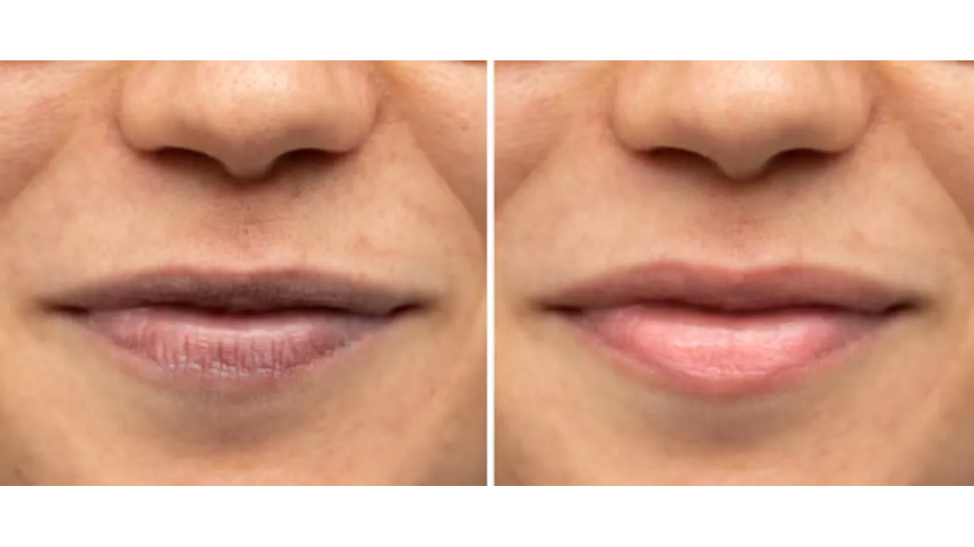 Best Solution for Dark Lips in T. Nagar – Enhancing Natural Lip Tone Safely