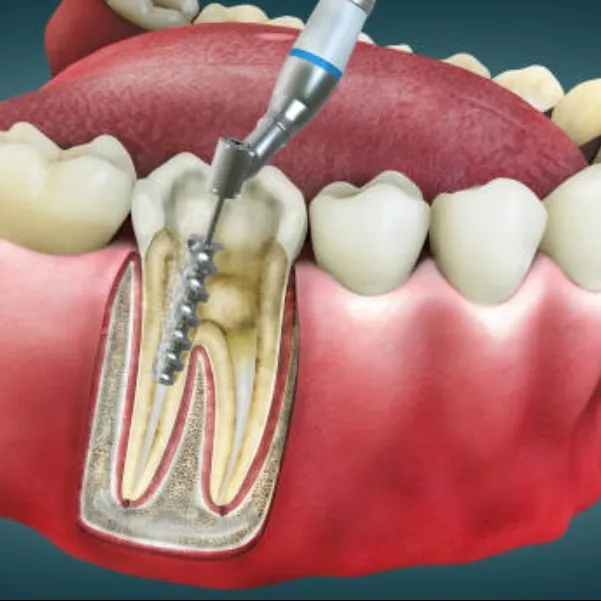 Root canal treatment in vashi
