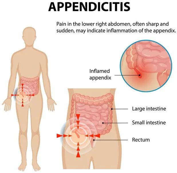 Appendicitis Treatment in Goregaon – Acting Early Makes All the Difference