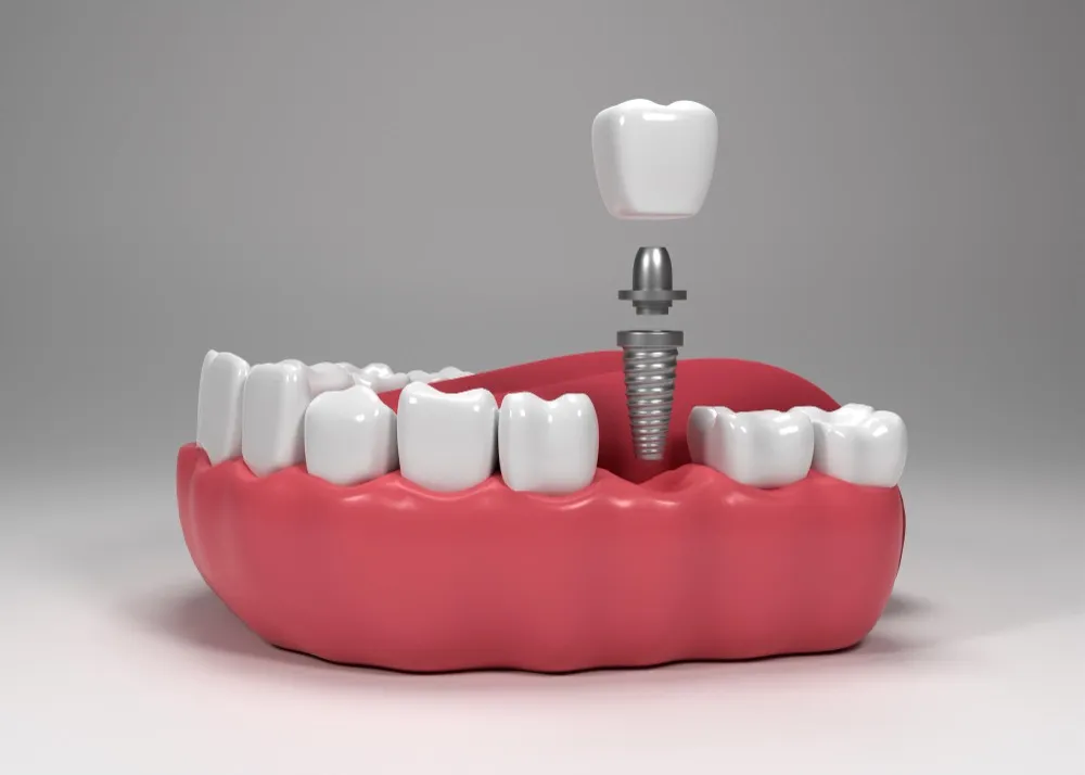 Best Dentist for Dental Implants in Dwarka – Restoring Smiles with Confidence