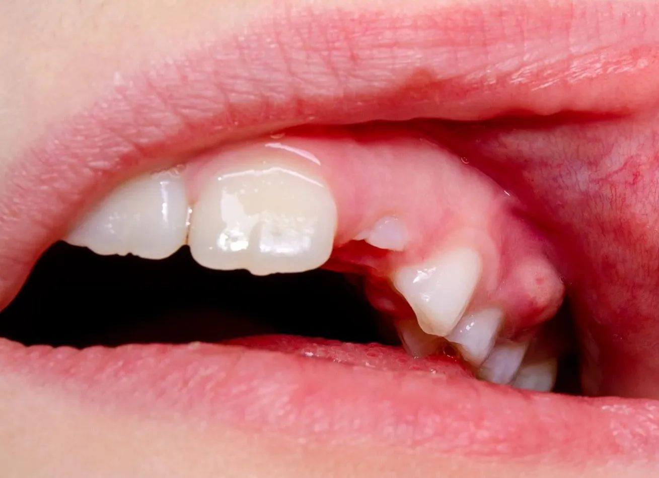 Gum Boils and Pus – When to See a Dentist Urgently
