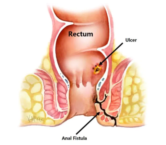 Fistula Treatment in hinjewadi