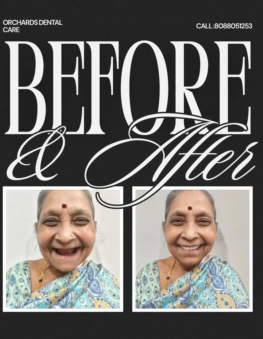 Complete Dentures in Sadashivanagar