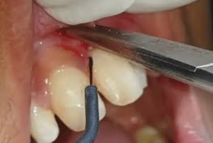 Electrocautery treatment in Lajpat Nagar at Madan Multispecialty Dental Care Center