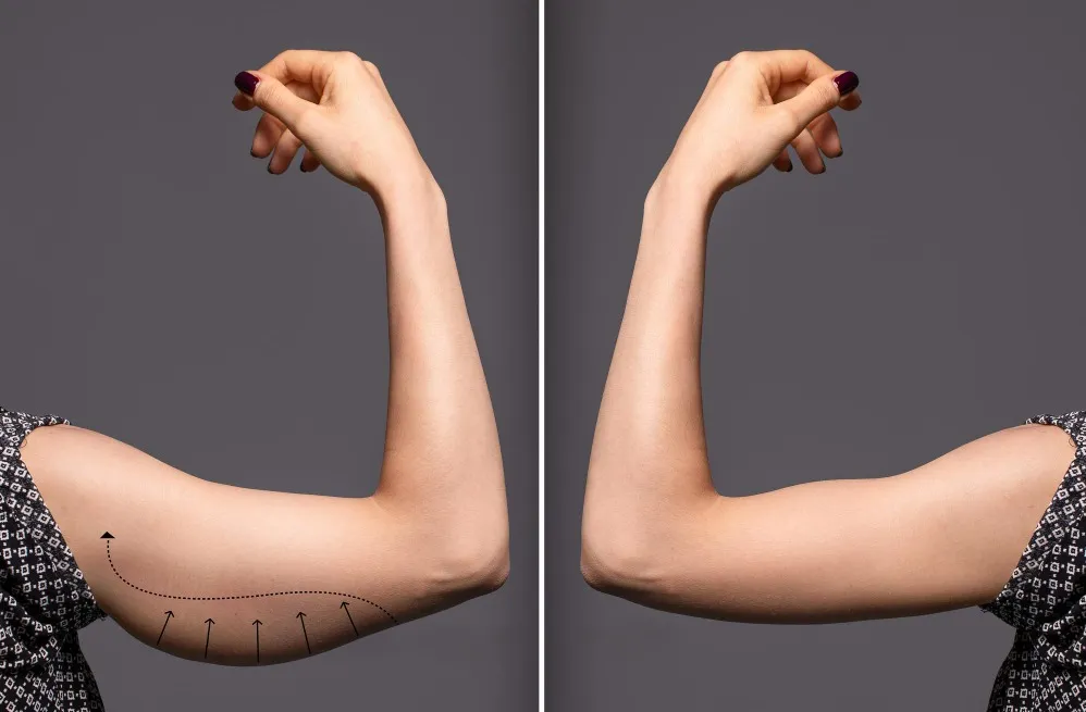 Arms Lift Surgery in Bengaluru – Restoring Firmness and Upper Arm Contours