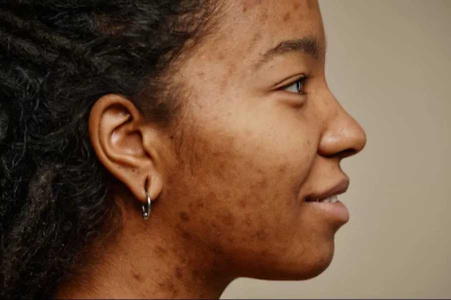 Pigmentation Treatment in Rohini - Restore Even Skin Tone and Radiance