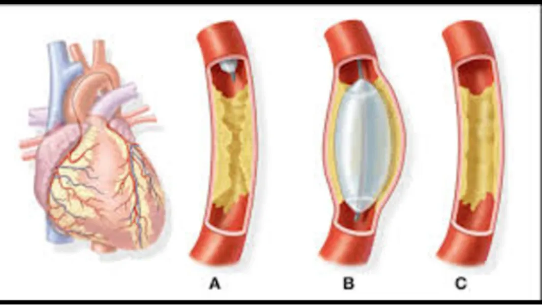 Angiography Treatment in Pune – Advanced Imaging for Accurate Heart Diagnosis
