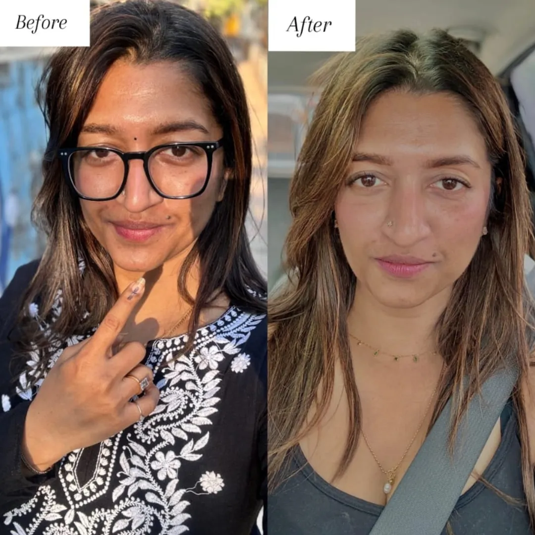 Best Microneedling in vashi
