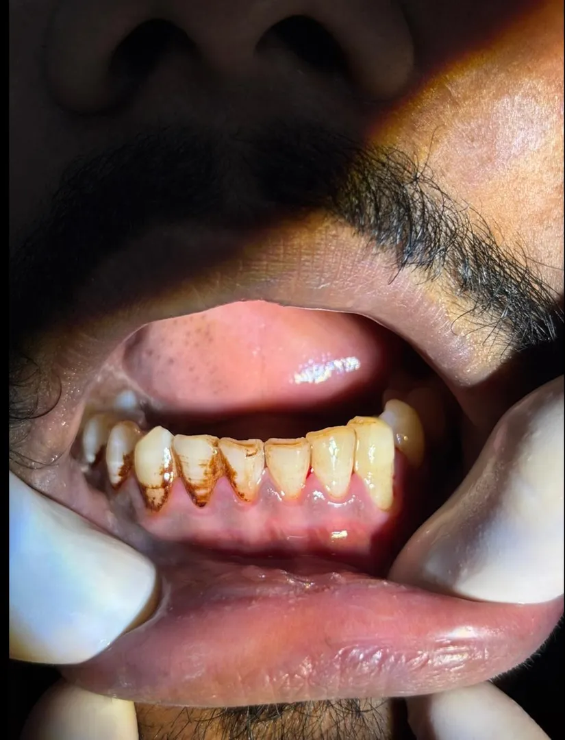 Top Foods and Drinks That Stain Teeth in Indian Diets