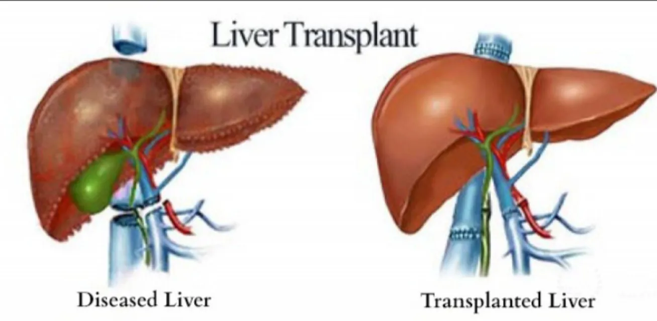 Liver Transplant in Mumbai