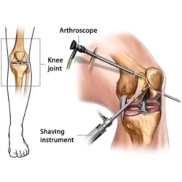ACL Reconstruction Surgery in Bangalore – Regaining Knee Stability and Control