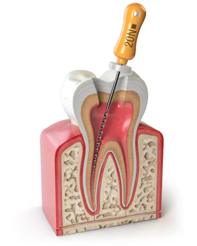 Painless Root Canal Treatment in Dwarka – Gentle Care That Eases Tooth Pain
