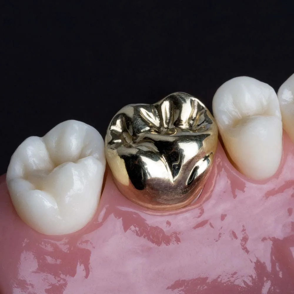 Full Metal crown Treatment In Vashi