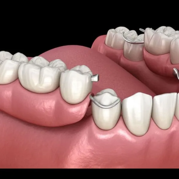 Removal partial Dentures Treatment In Vashi