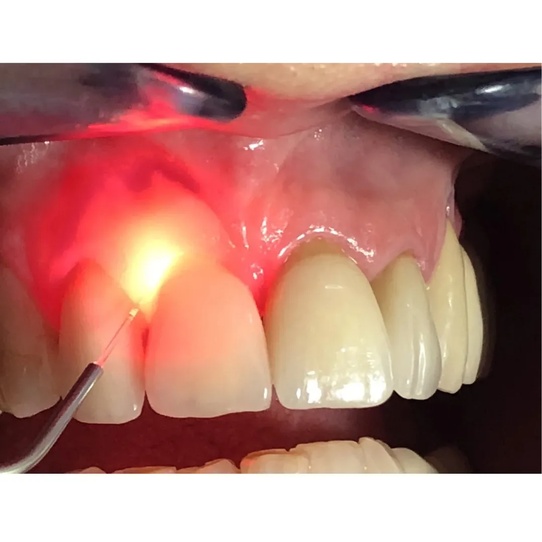 Laser Biostimulation Therapy
