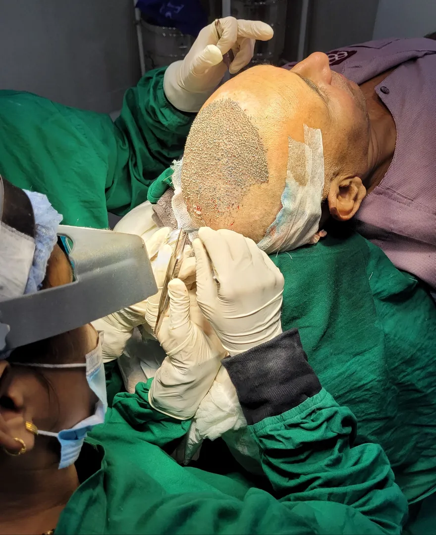 Recovery after Hair Transplant Surgery