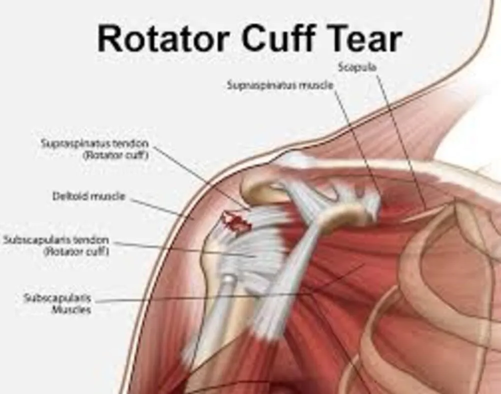 Rotator Cuff Tear Treatment in Nagpur – Restoring Shoulder Confidence