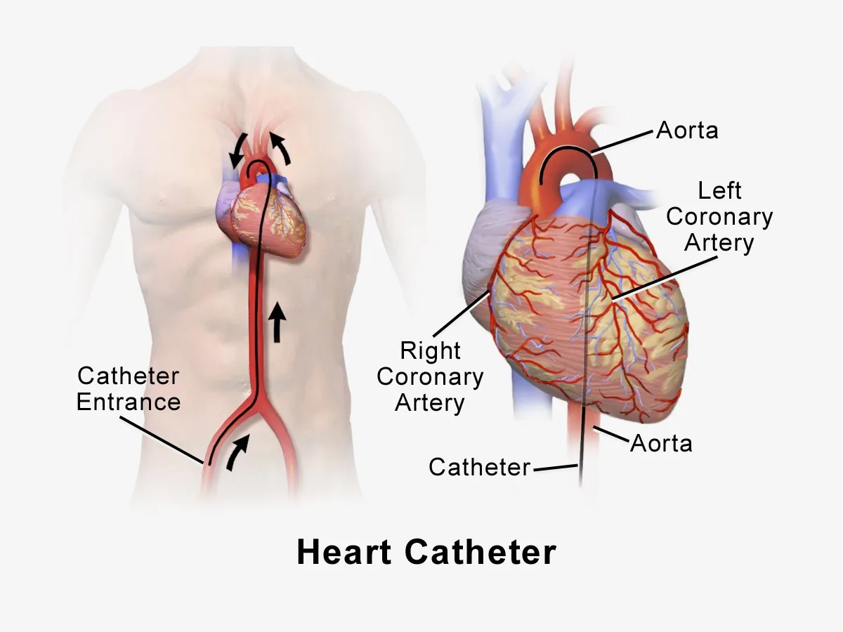 Angiography in Pune