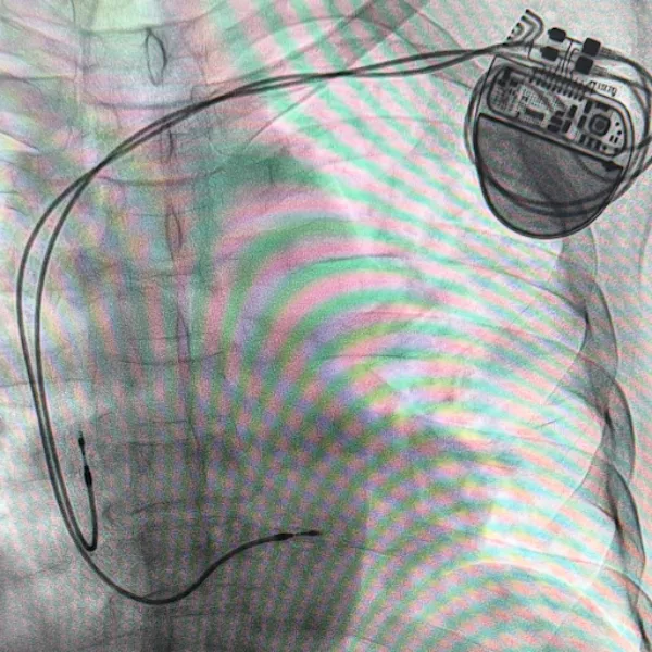 Pacemakers Surgery in Pune – Reliable Rhythm Management for Heart Health