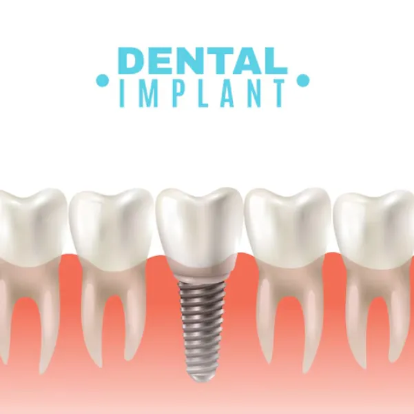 Immediate Dental Implants in Dwarka – Getting Back to Life Faster
