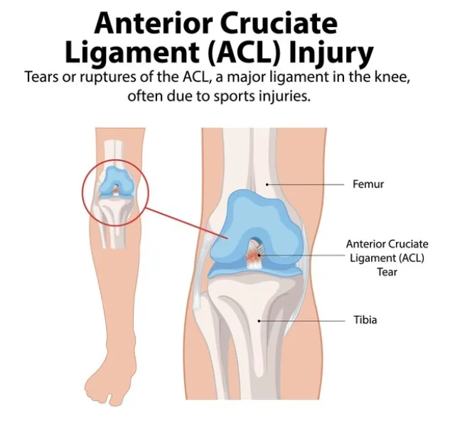 Arthroscopy ACL Reconstruction in Nagarbhavi, Bangalore