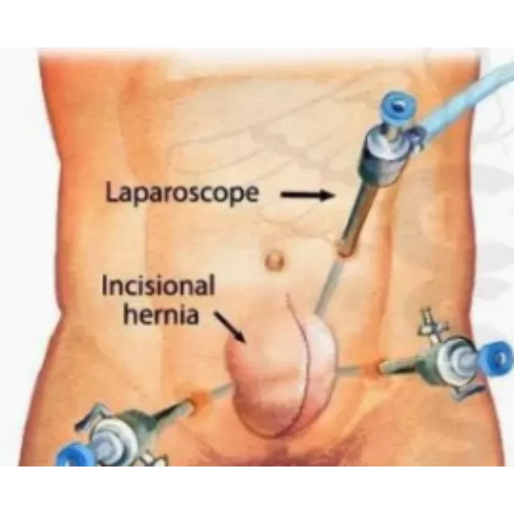 Laparoscopic Hernia Repair Surgery in Thane | Advanced Mesh Surgery for Long Lasting Comfort