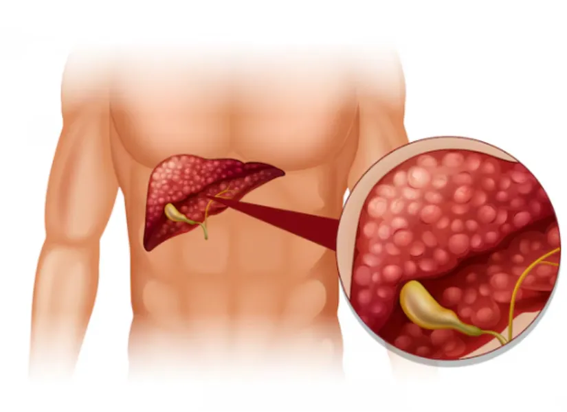 Gall Bladder Stone Treatment in kalewadi